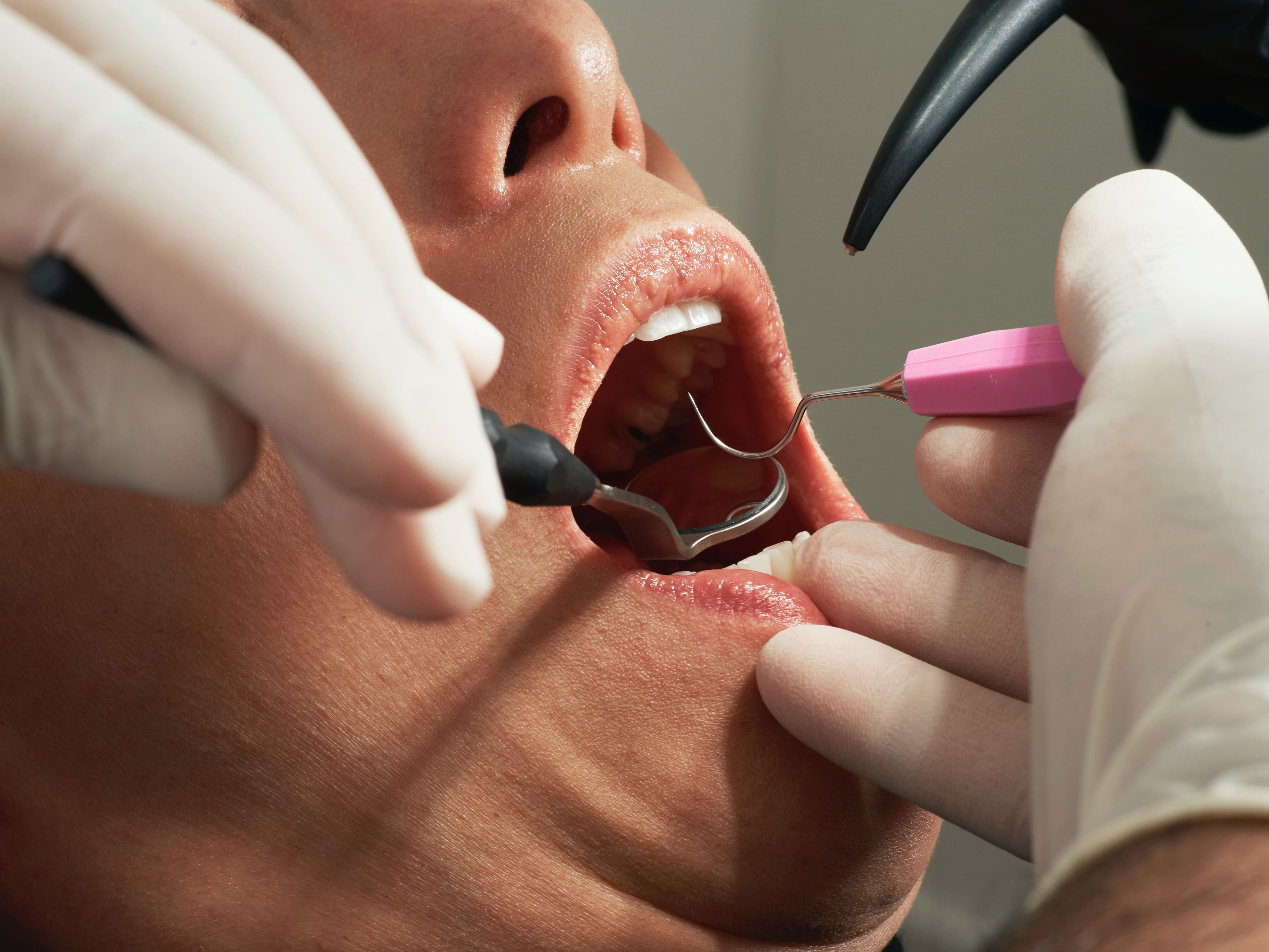 Dental Emergencies: How Cypress Dental Heroes are Making a Difference in Saving Teeth and Lives