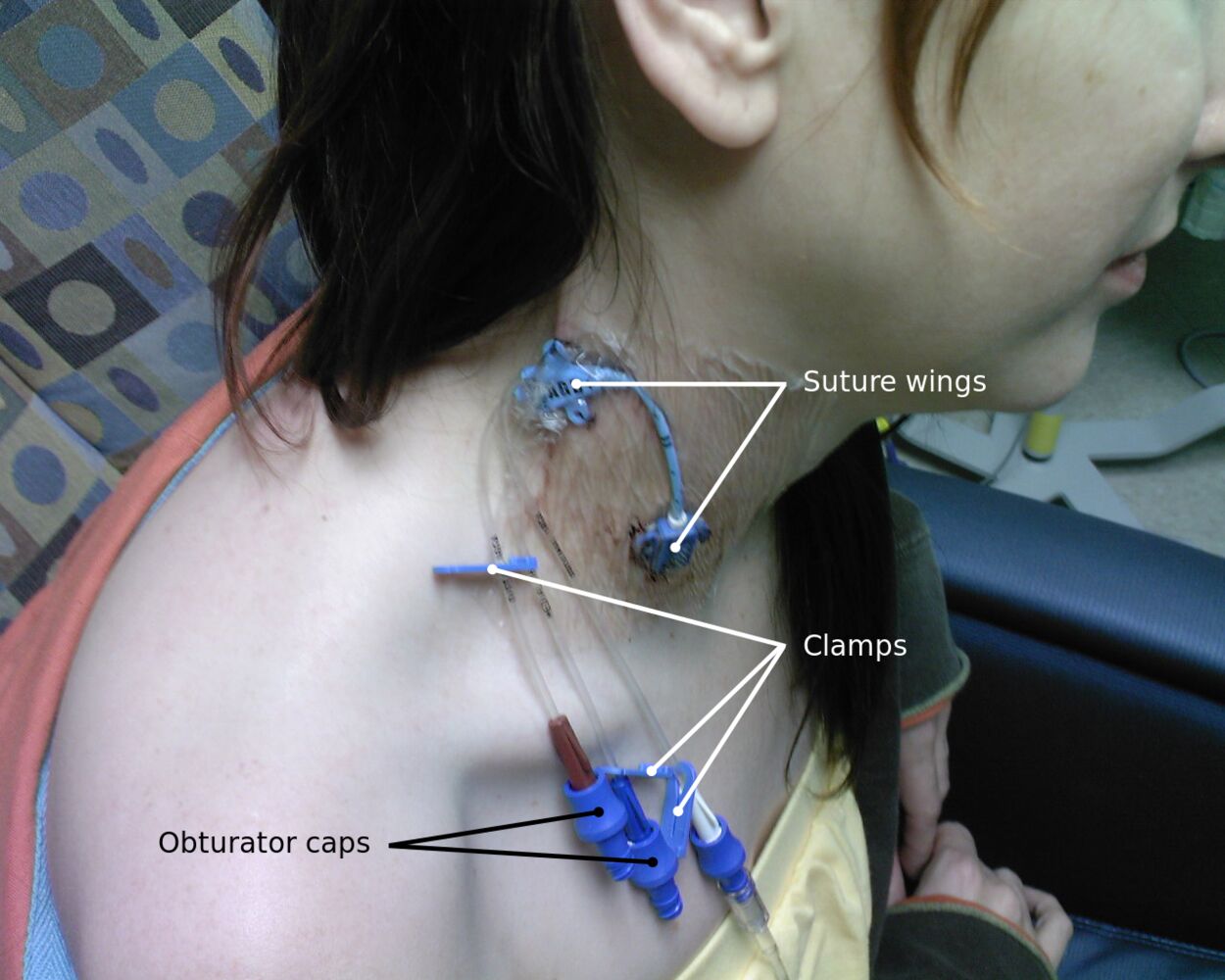 Central Venous Catheter Market Primed For Growth