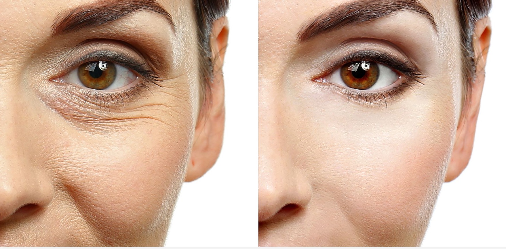 Treatment for Wrinkles on Face: A Detailed Guide
