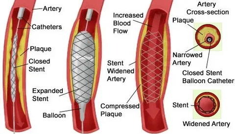 Stent Materials Market Size, Share, Trends & Growth Report by 2032: AMR 