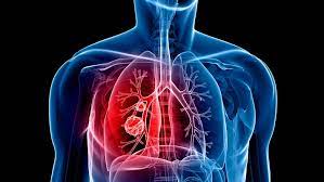 Global Lung Disease Therapeutics Market 2022: COVID-19 Impact Analysis and Industry Forecast Report, 2030