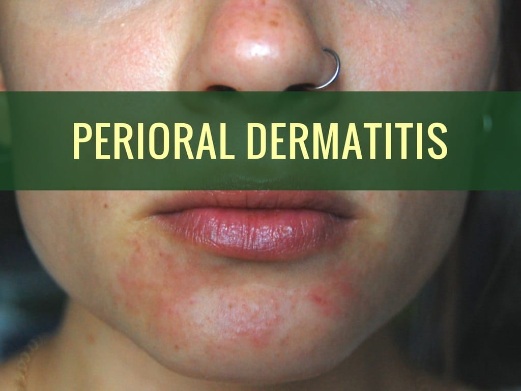 Perioral Dermatitis Treatment Market Size, Status, Growth | Industry Analysis Report 2022-2030