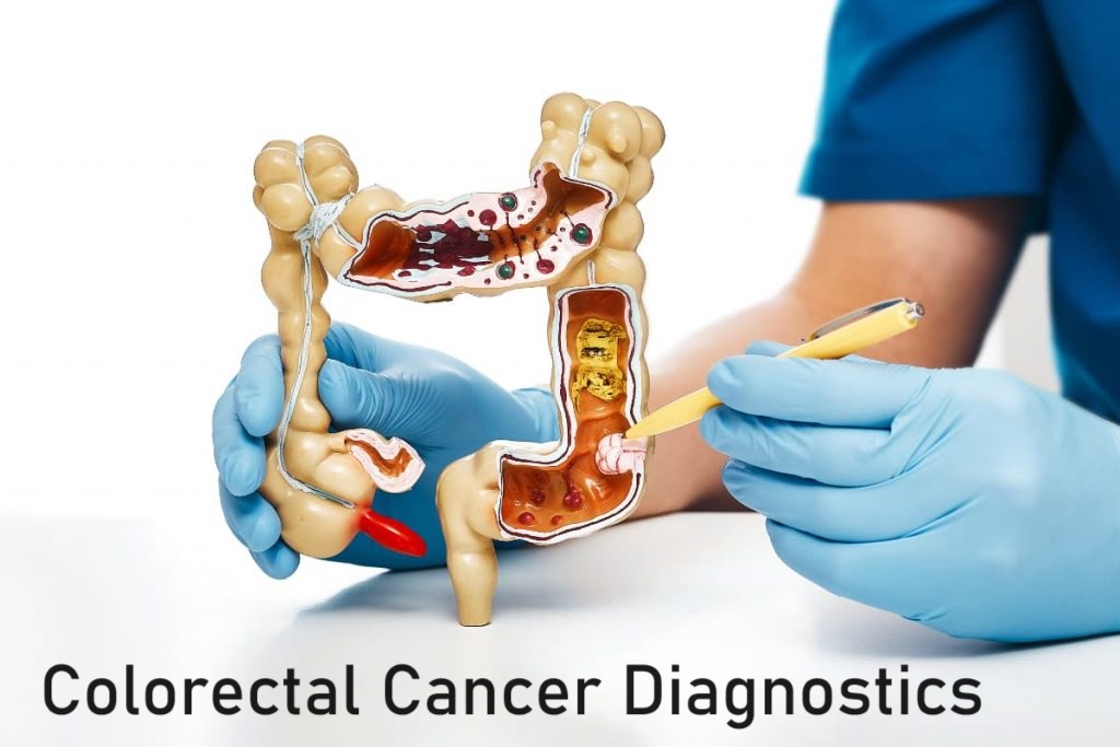 Global Colorectal Cancer Diagnostics Market 2022: COVID-19 Impact Analysis and Industry Forecast Report, 2030