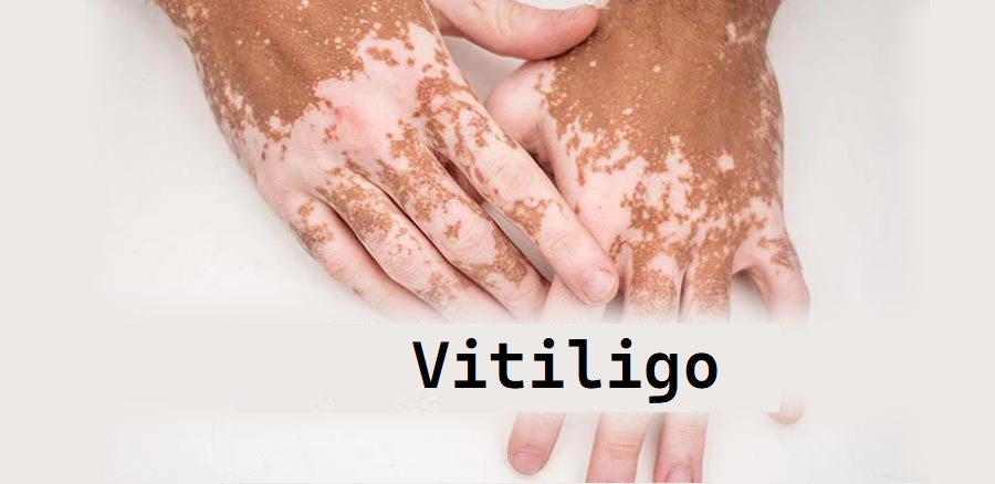 Vitiligo Market Size, Status, Growth | Industry Analysis Report 2022-2030