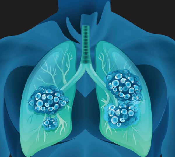 Global Non-small Cell Lung Cancer Market Report, Latest Trends, Industry Opportunity & Forecast to 2030
