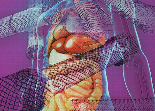 Global Gastrointestinal Stents Market 2022: COVID-19 Impact Analysis and Industry Forecast Report, 2030