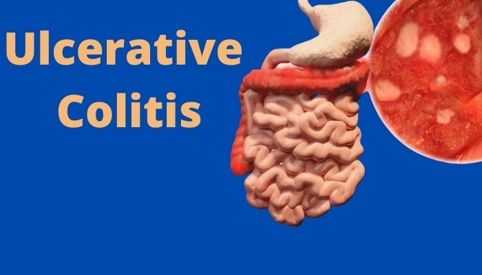 Ulcerative Colitis Market Size, Share, Growth, Opportunities and Global Forecast to 2030