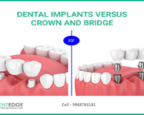 Implant Supported Dentures - Dentedge