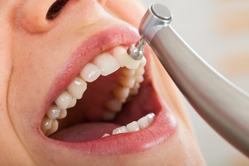 What More Do You Need To Know About Teeth Cleaning?