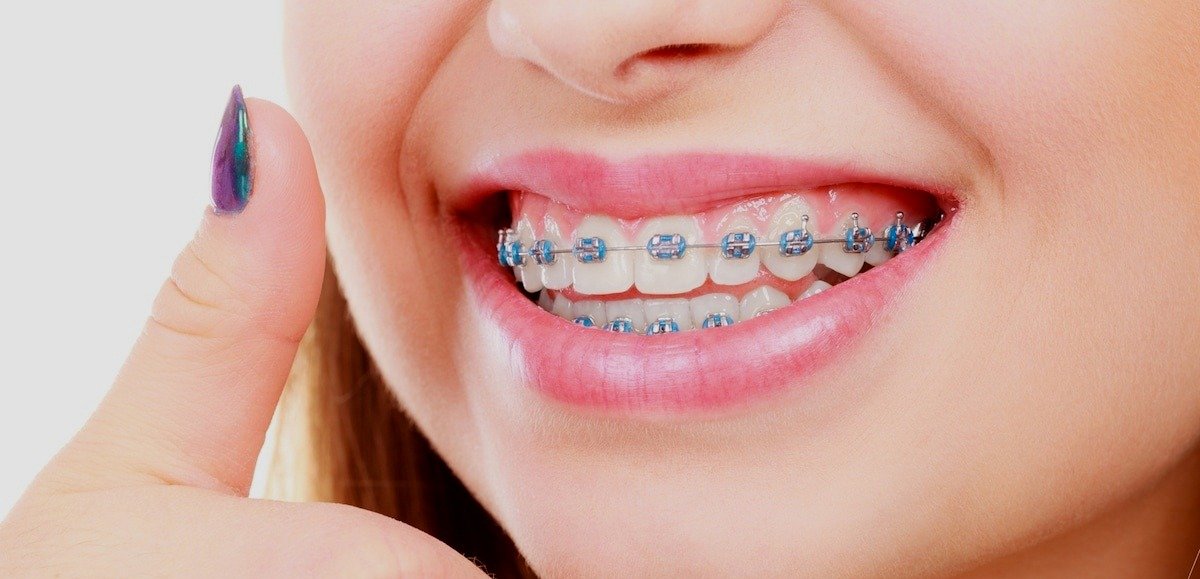 What Are The Pros And Cons Of Teeth Whitening?