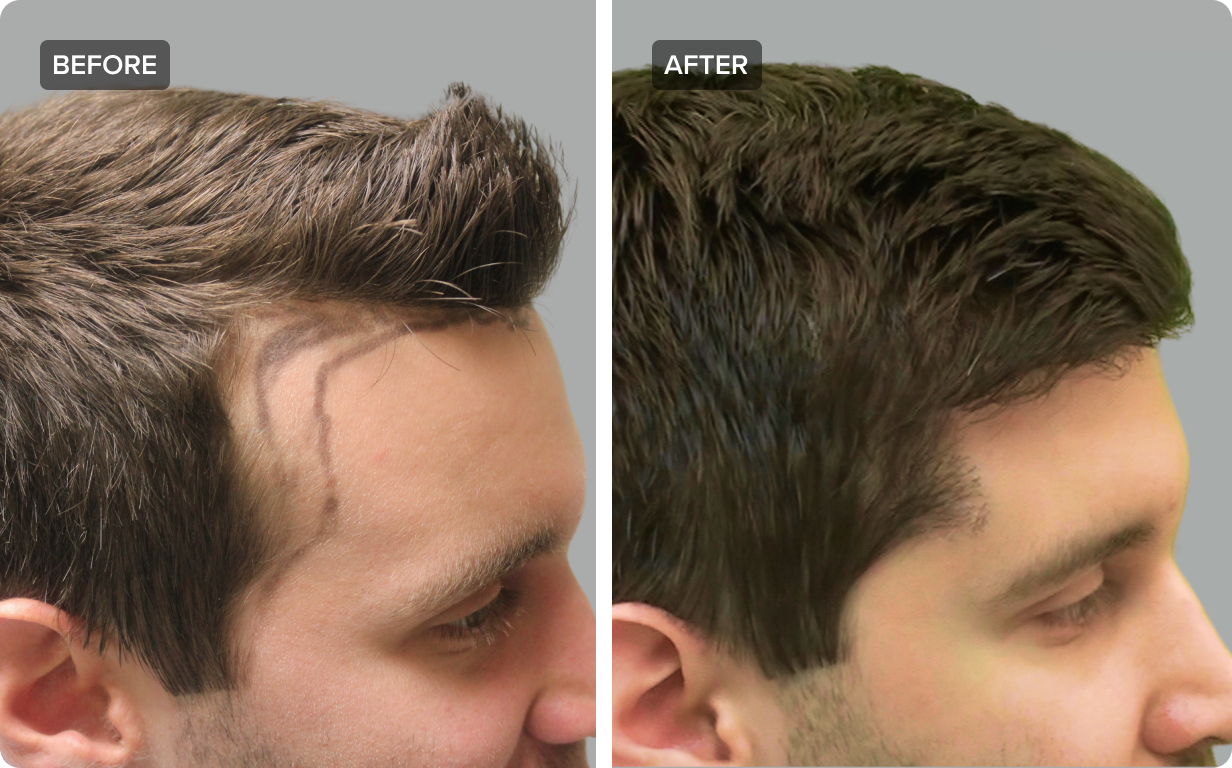 The Ultimate Guide to Finding the Best Hair Transplant in Delhi