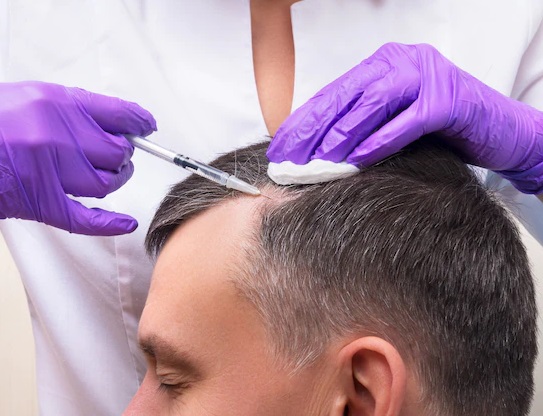 Why PRP Hair Treatment is the Best Solution for Hair Loss in Delhi