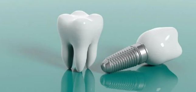 Reviving Smiles: How a Dentist in Nanaimo Transforms Lives with Dental Implants