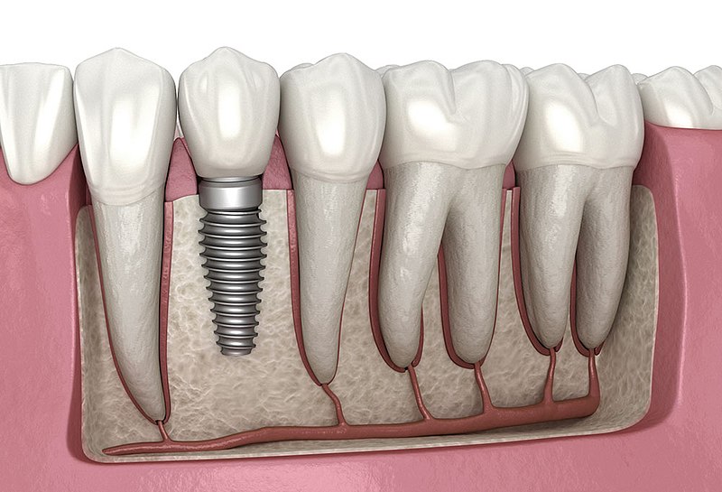 Dental Implants in Oakville: Restoring Smiles with Precision