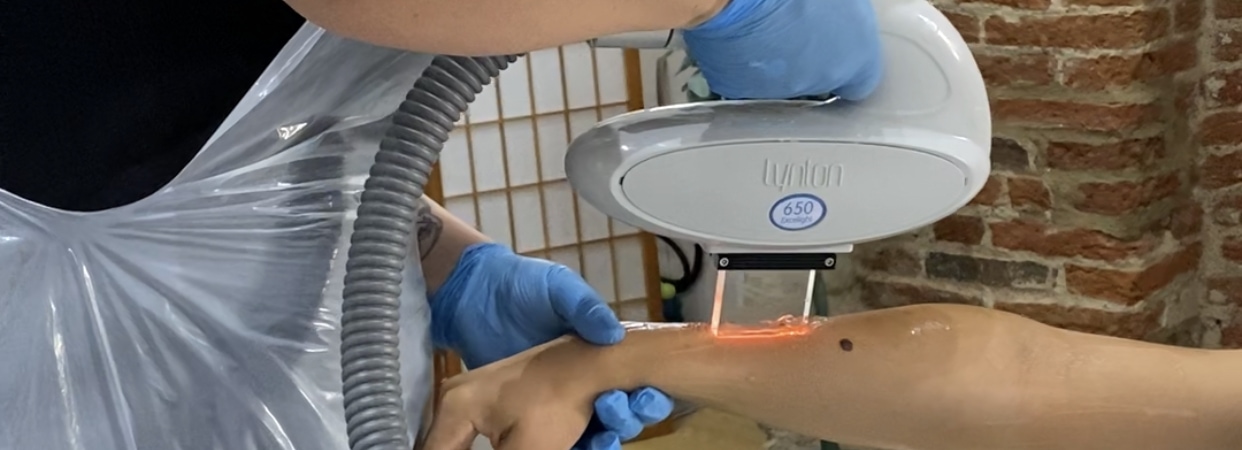 IPL Hair Removal London