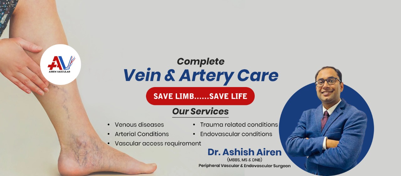 Tips for Choosing the Right Varicose Vein Specialist