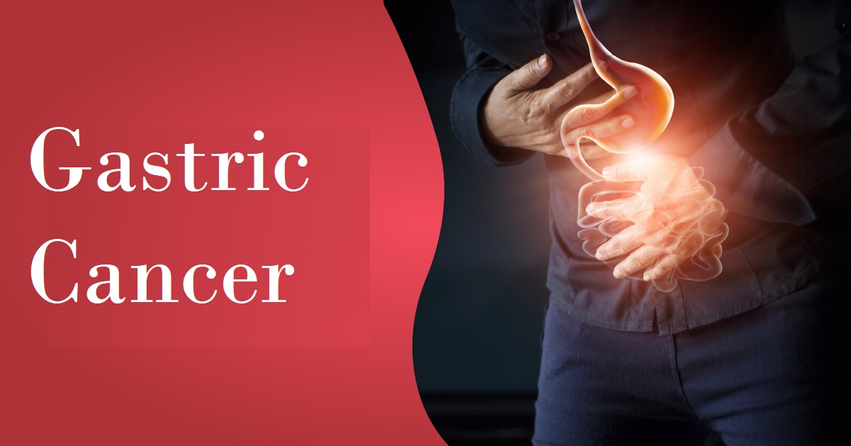 Gastric Cancer Market 2022 | Industry Demand, Fastest Growth, Opportunities Analysis and Forecast To 2030