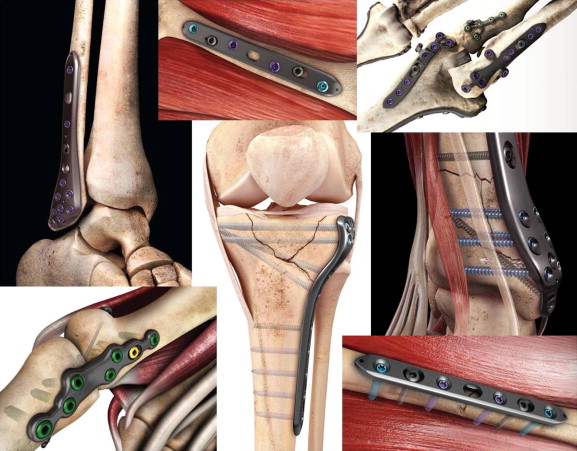 Medical Composites Market 2022 Major Key Players and Industry Analysis Till 2030