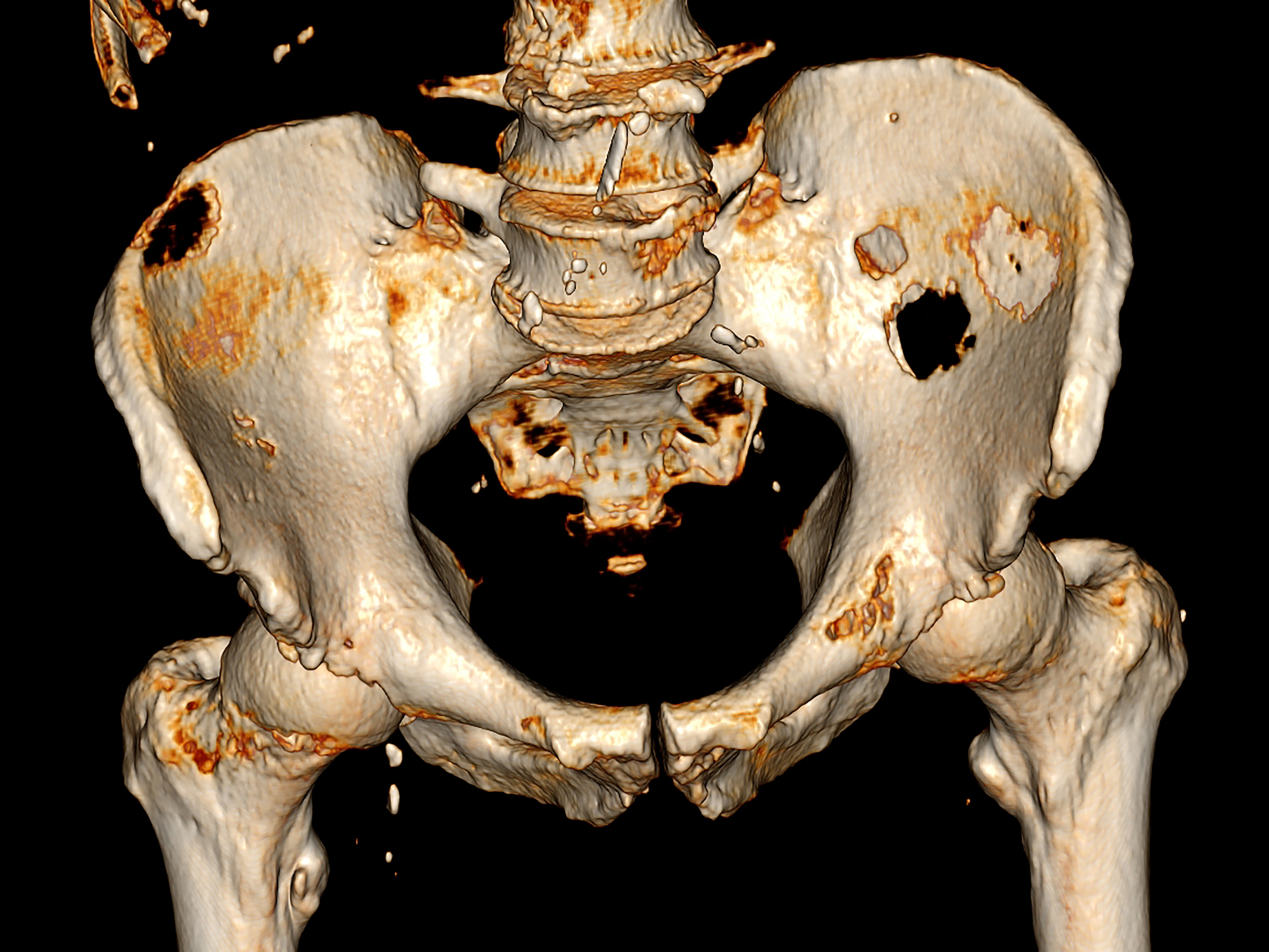 Bone Metastasis Market 2022 Major Key Players and Industry Analysis Till 2030