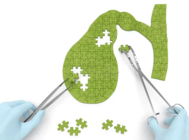 Evolution of Cholecystectomy Devices: Precision Surgery in the Gallbladder Realm
