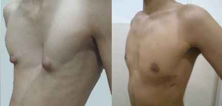 Selecting the Best Thoracic Surgeon in India