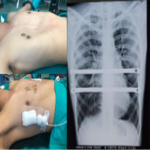 Pectus Deformity Clinic in Delhi: Embracing Freedom and Defying limits