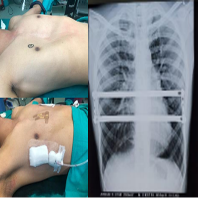 Understand the Facts about Lung Transplant