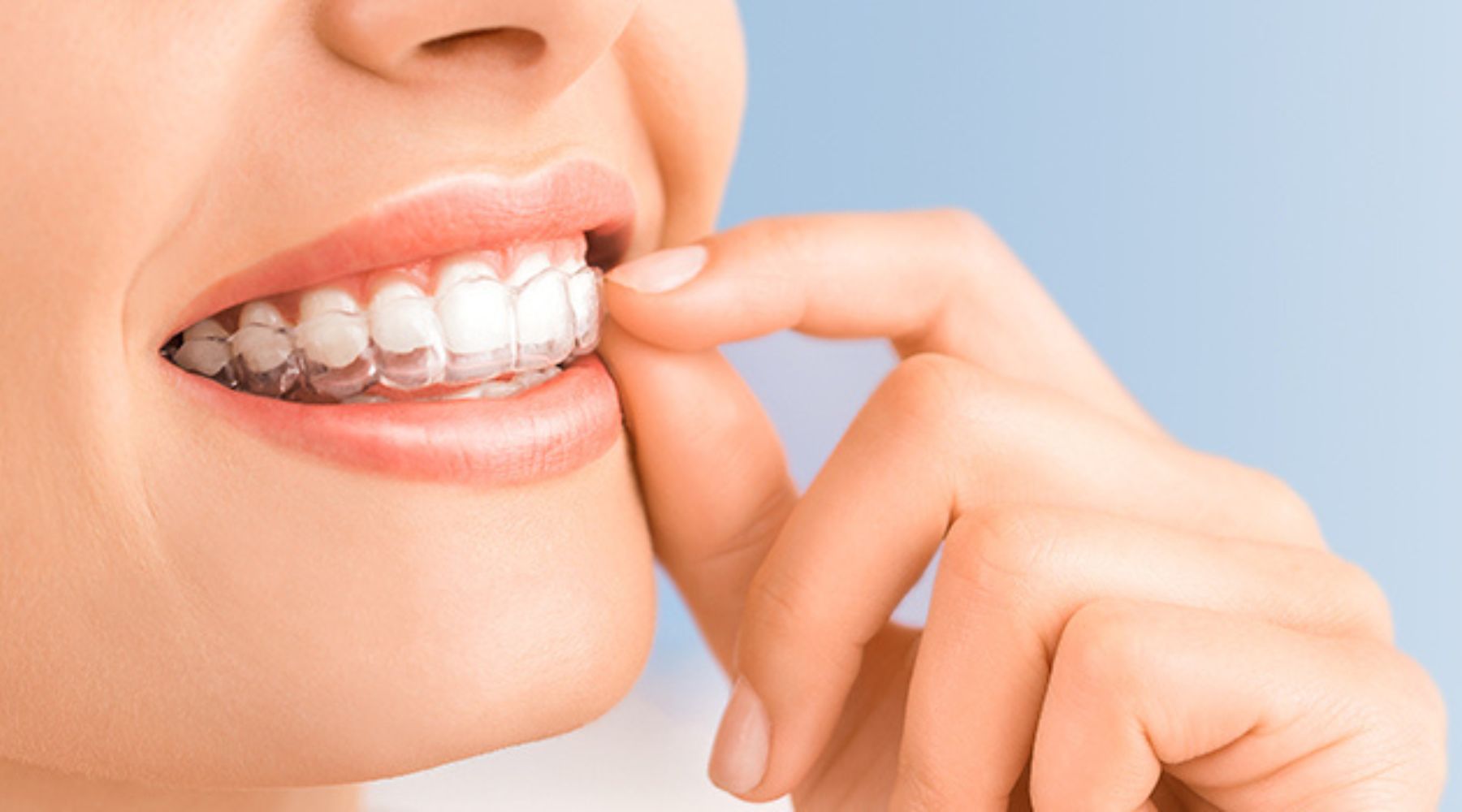 Unlocking a Brighter Smile with Boca Raton Invisalign