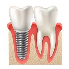 Dental Implant Surgery: What You Need To Know