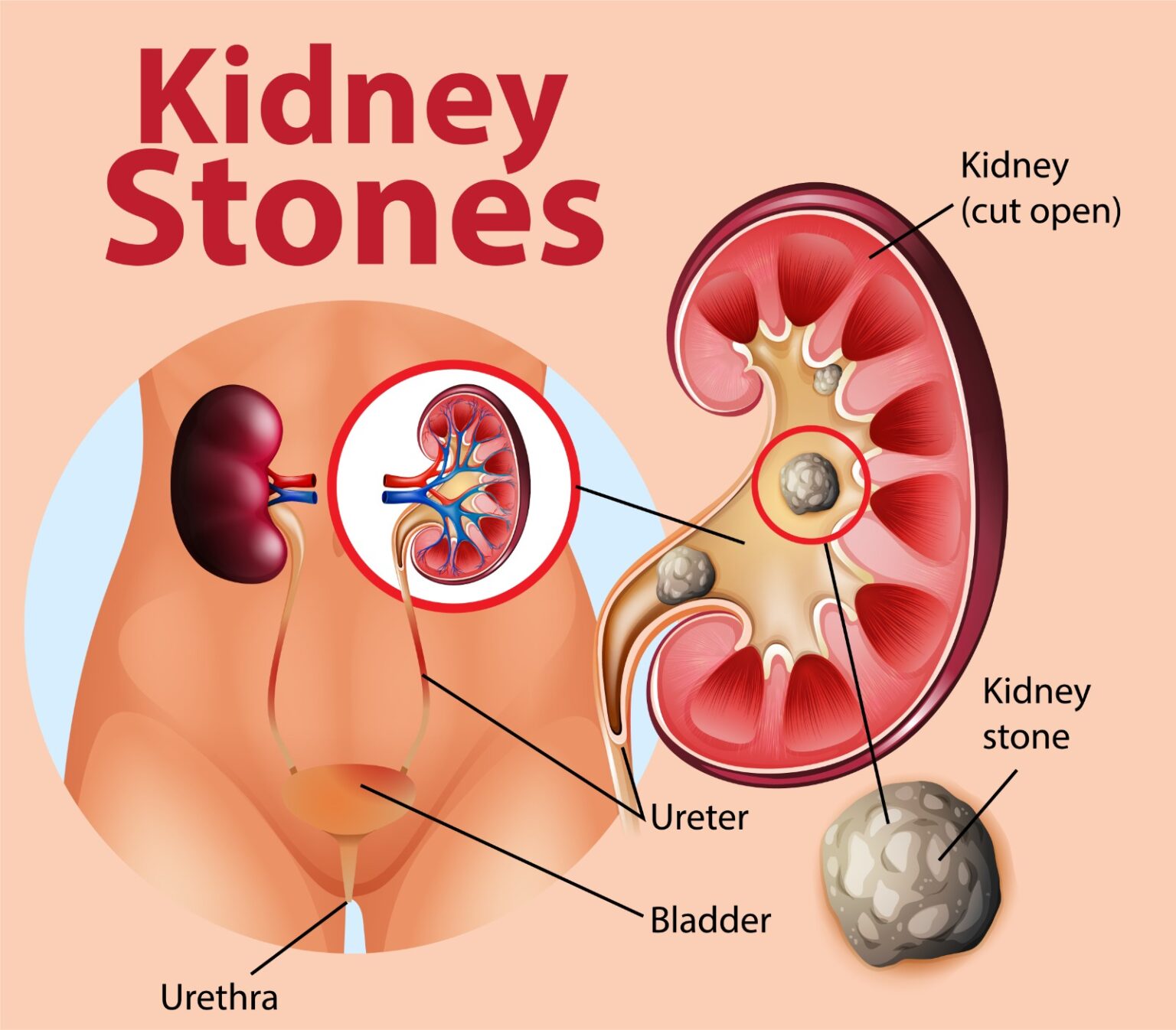 10 Symptoms and Causes of Kidney Stones