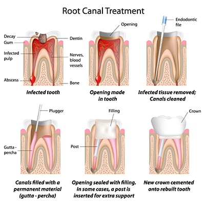 Emergency Dental Care in Eltham: What to Do When Dental Issues Strike
