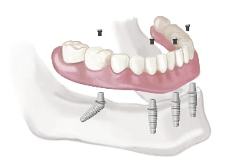 Family Dentistry in Eltham: Comprehensive Care for Every Smile