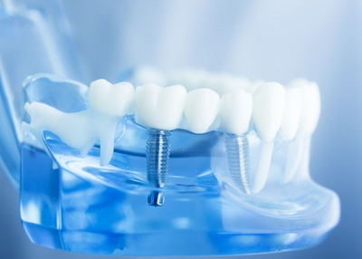 5 Essential Care Tips for Dental Implants