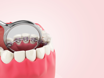 Lingual braces los angeles