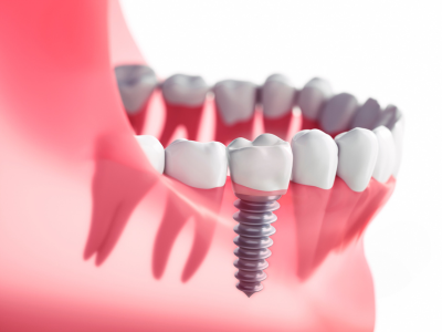 Dental Implants Woodland Hills