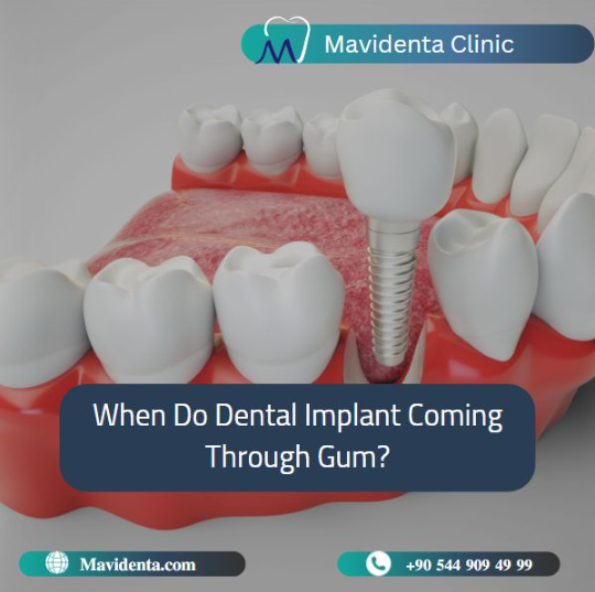 Best Dental Implant Clinic In Istanbul