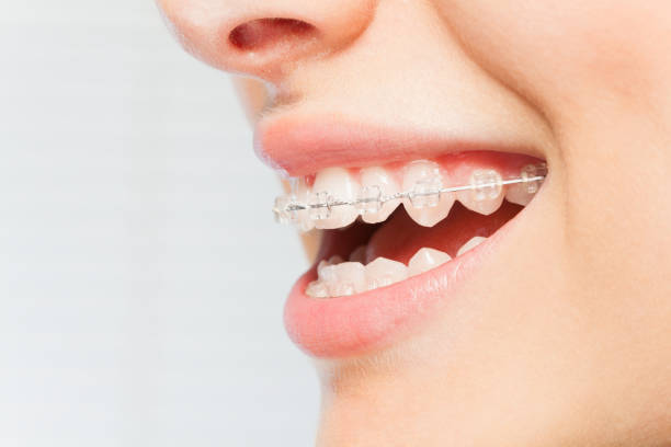 Smile Aligned: Navigating Your Braces Treatment with Confidence