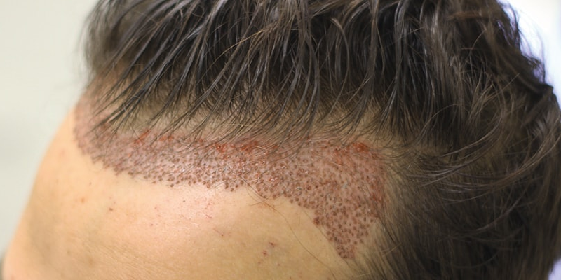 Revitalize Your Hair with the Leading Hair Clinic in Delhi