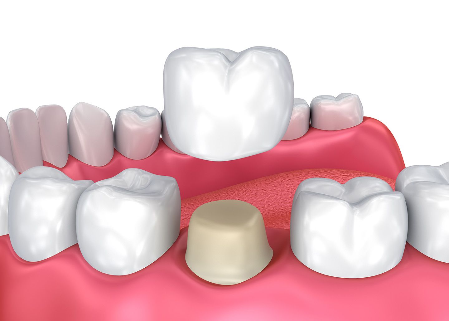 Understanding Dental Crowns: A Comprehensive Guide