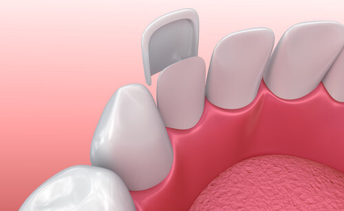 Smile Confidently with Veneers in Ventura: Discover the Benefits Today