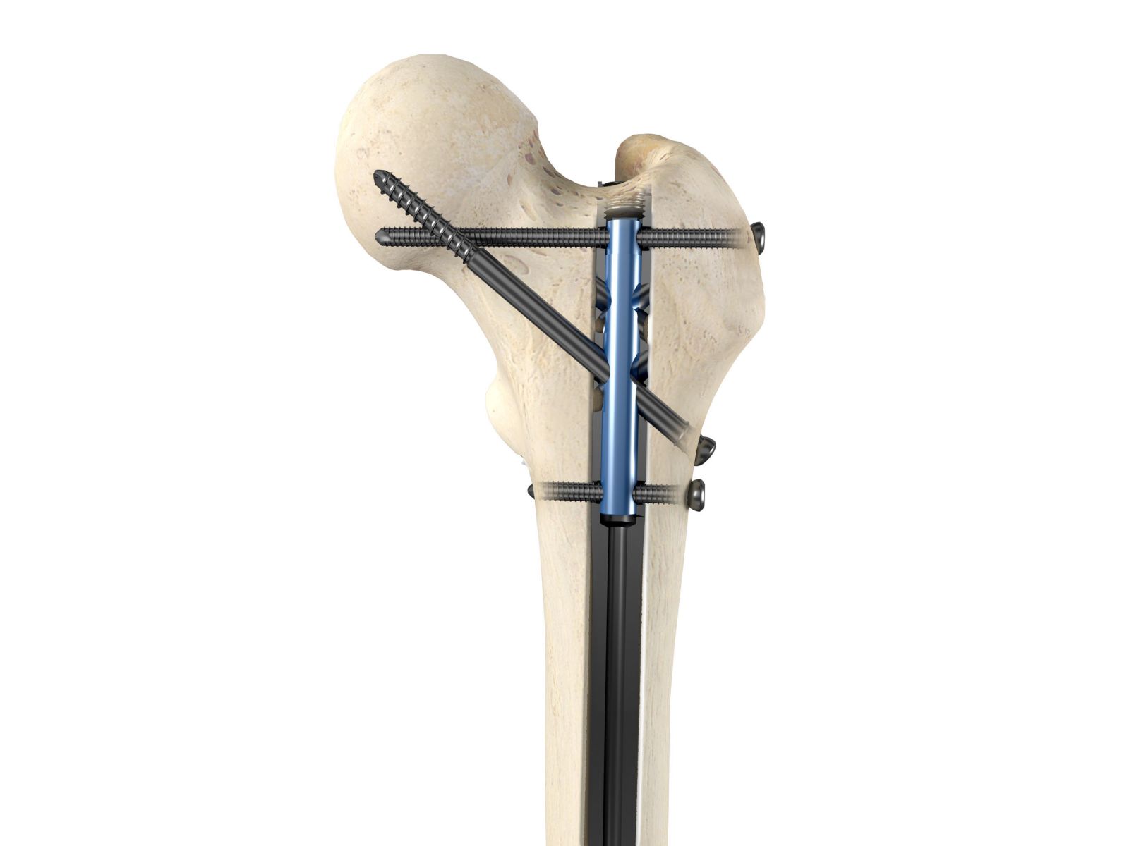 Intramedullary Nail Market is Estimated to Witness High Growth Owing to Opportunity in Trauma Segment   