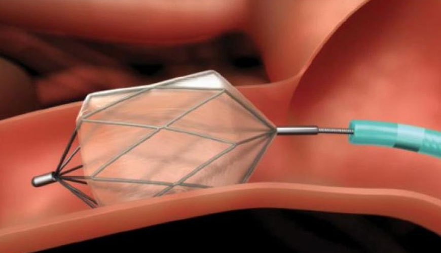 Patient Monitoring Is Fastest Growing Segment Fueling The Growth Of Nitinol Medical Devices Market