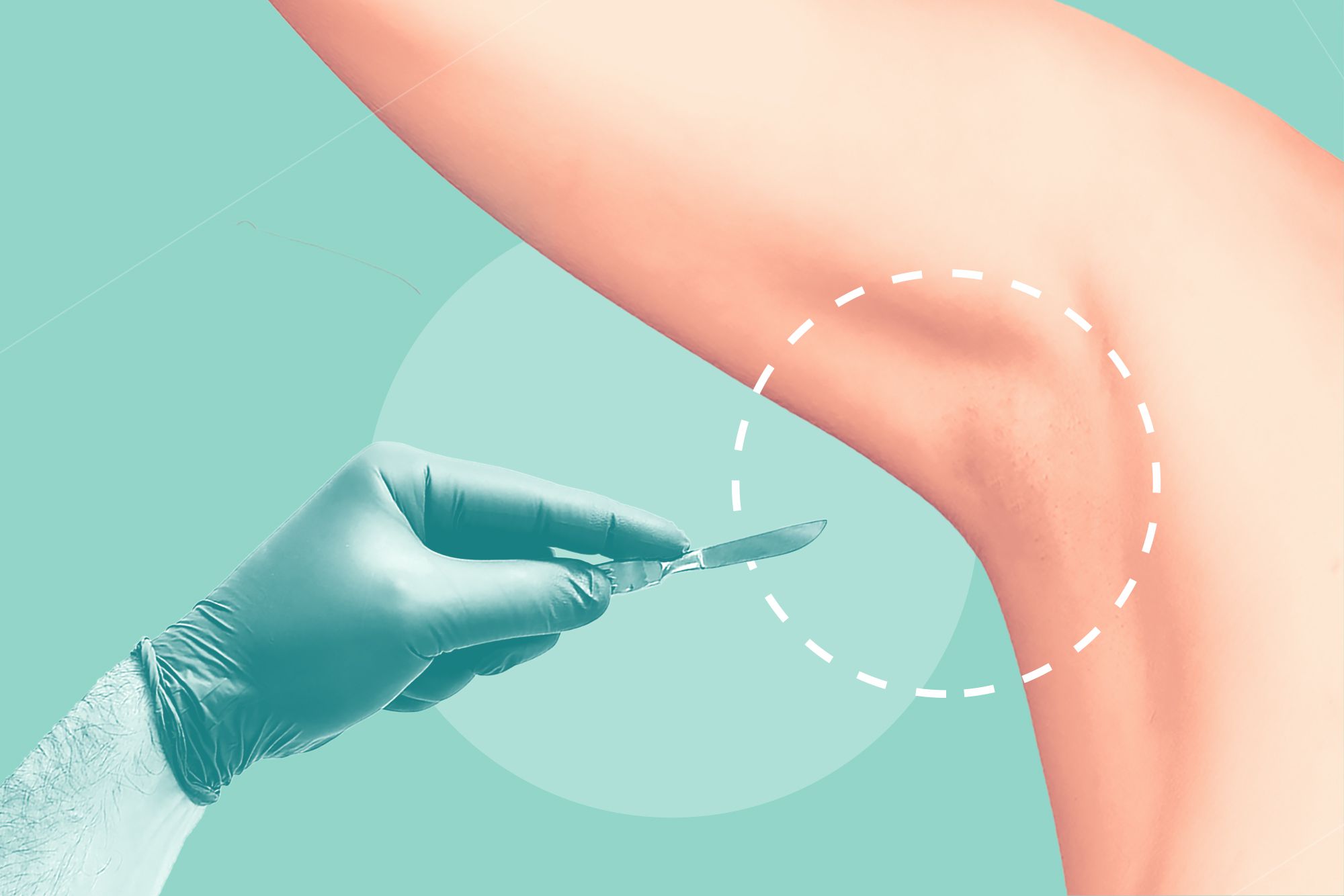 Rising Adoption Of OTC Drugs Are Fueling The Growth Of Hyperhidrosis Treatment Market