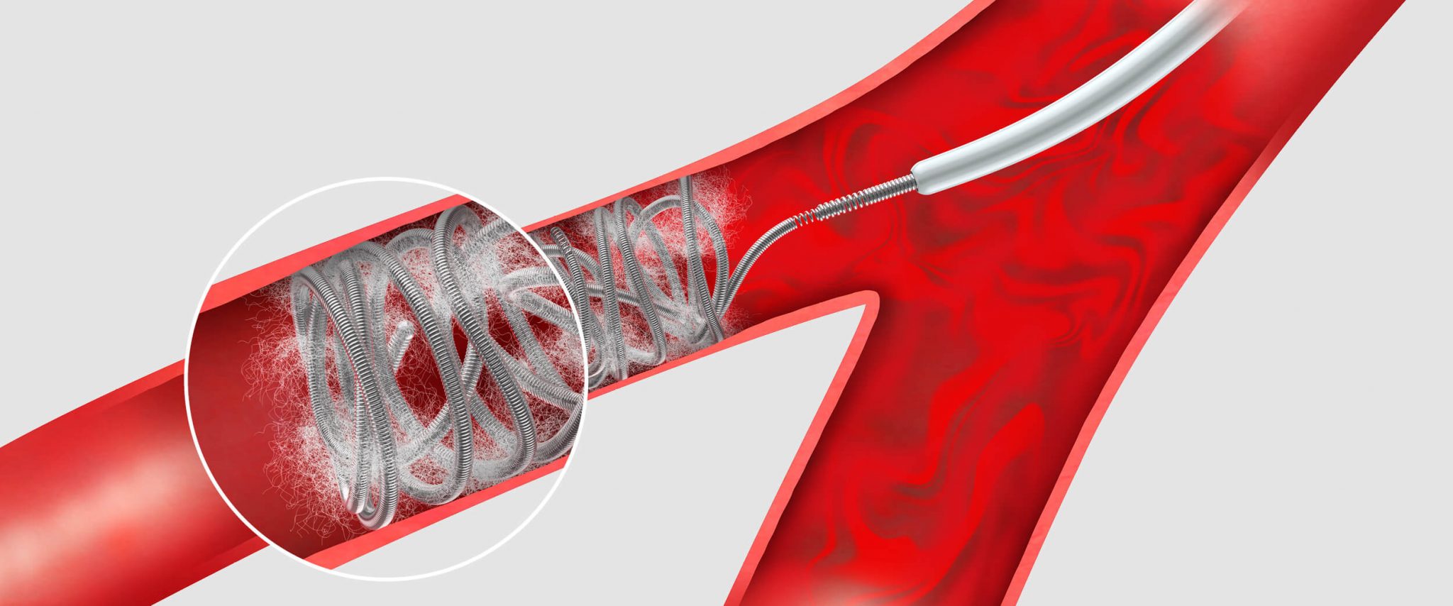 Embolization Market Growth Accelerated By Adoption In Minimally Invasive Procedures
