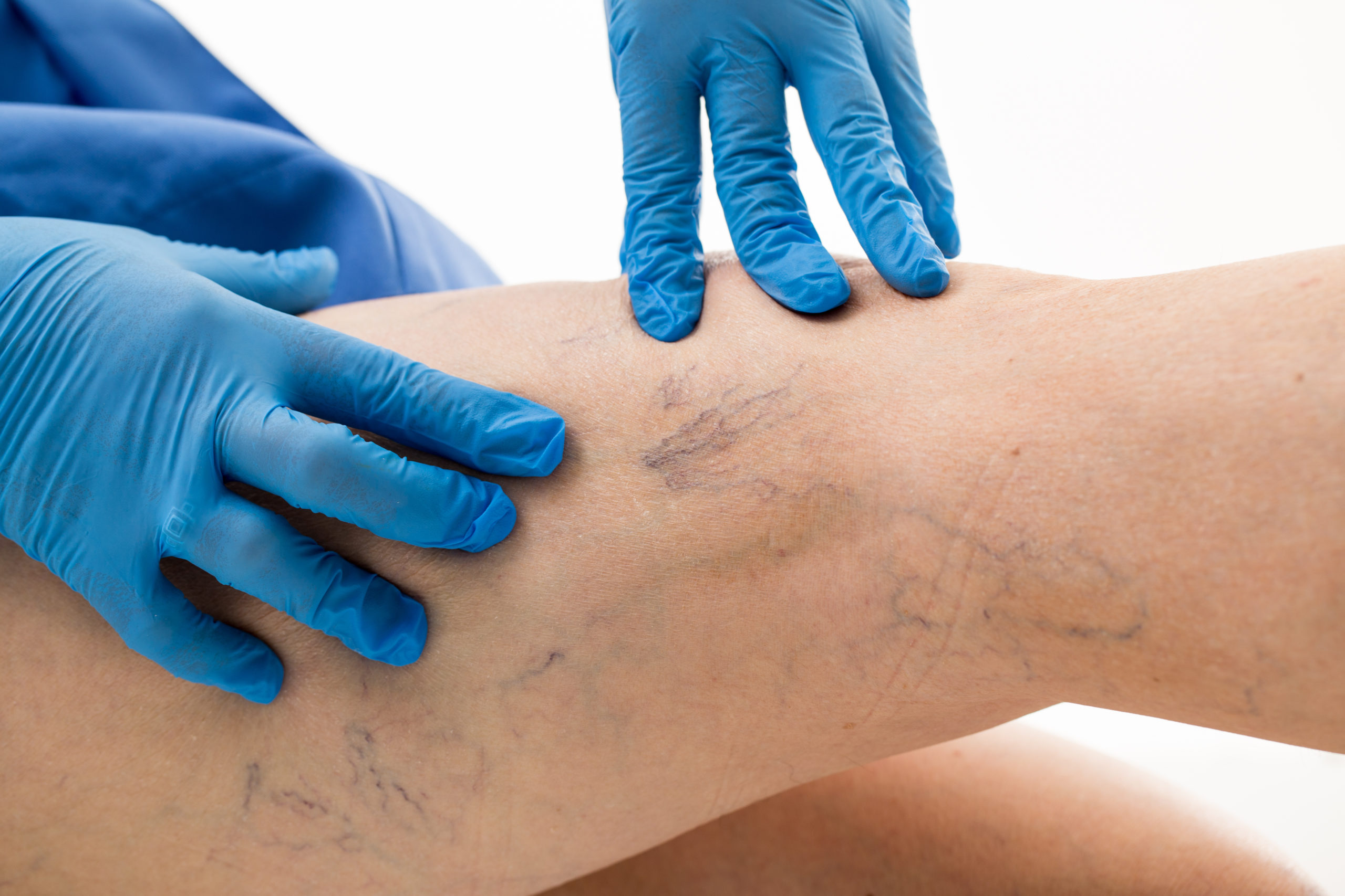 Minimally Invasive Vein Treatment Is Fastest Growing Segment Fueling The Growth Of Varicose Vein Treatment Devices Market