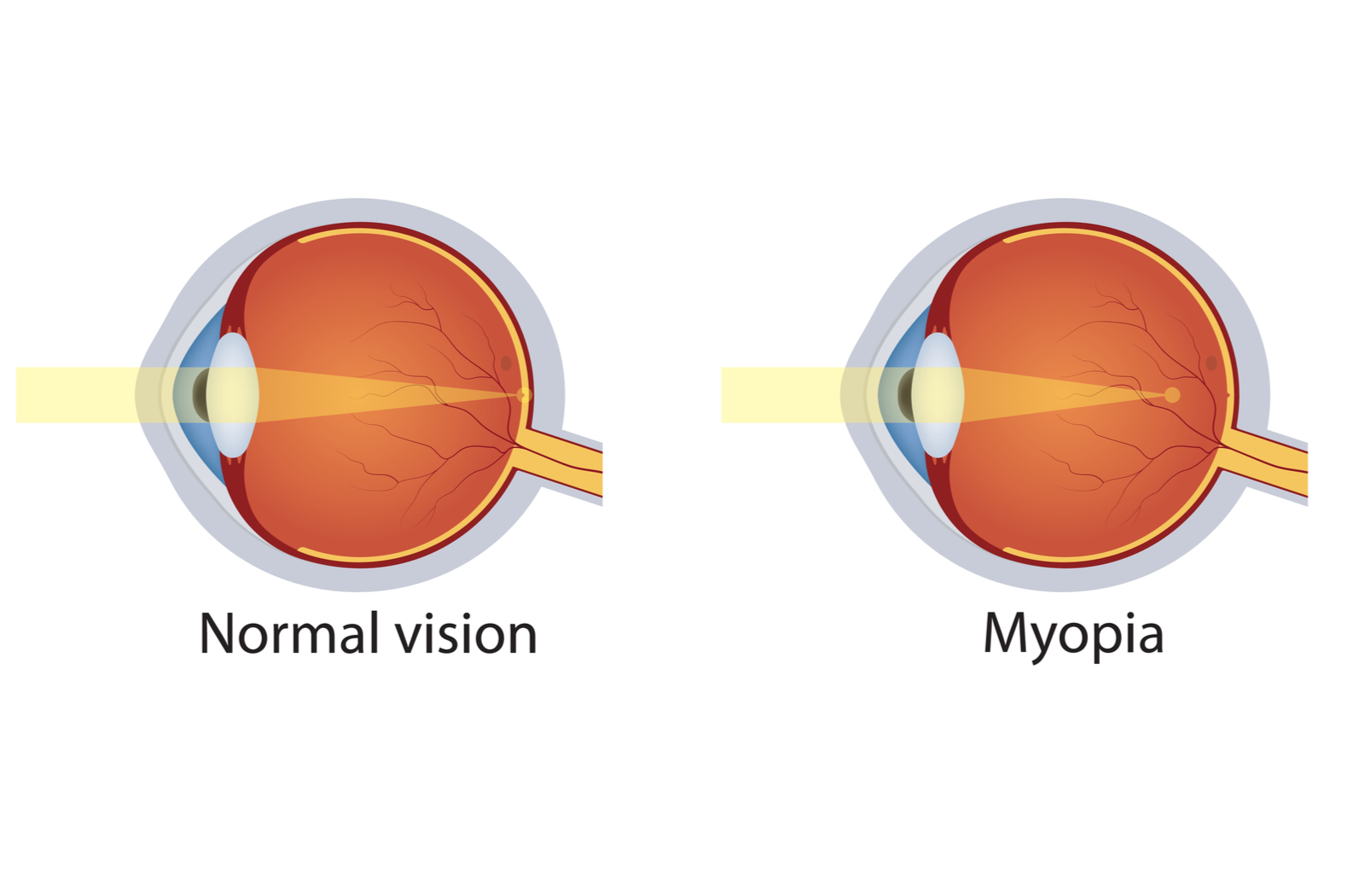 Myopia Control Lenses Market Growth Accelerated By Increased Awareness Among Parents    