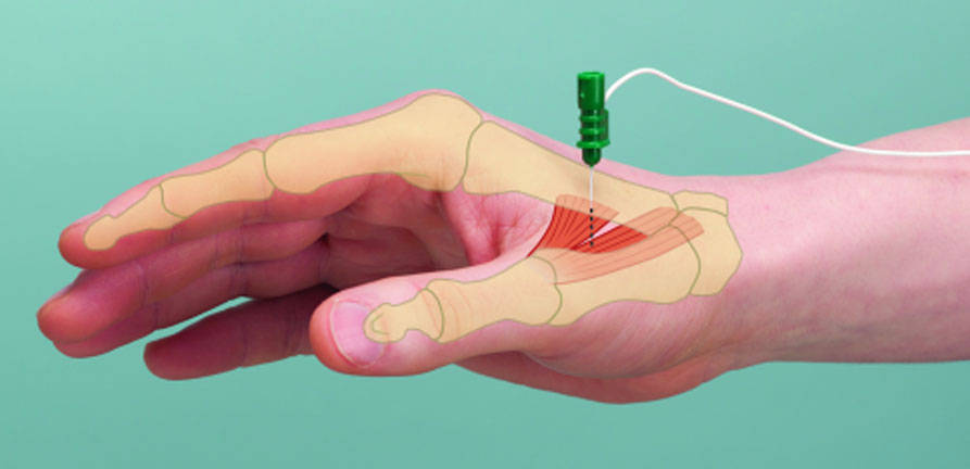 The global Muscle Spasticity Market Growth Accelerated by Adoption of Physical Therapy