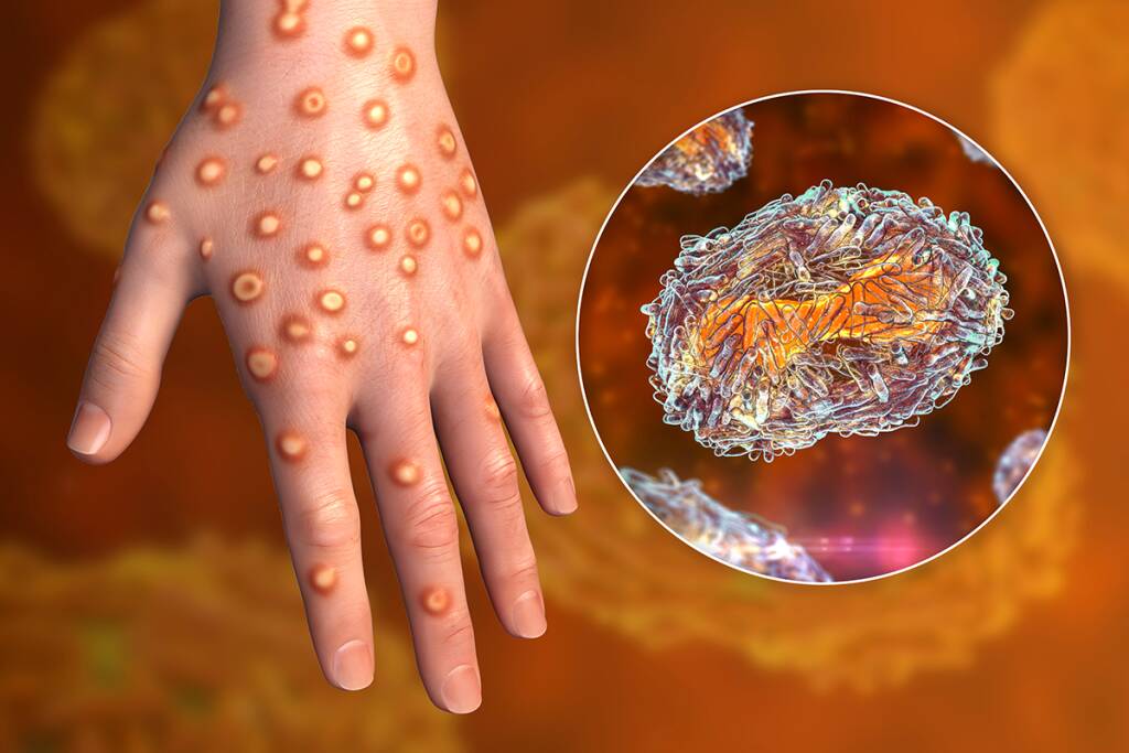 Growth Accelerated by Rising Prevalence of Monkeypox Infections, The global Monkeypox Treatment Market to Witness Increasing Growth