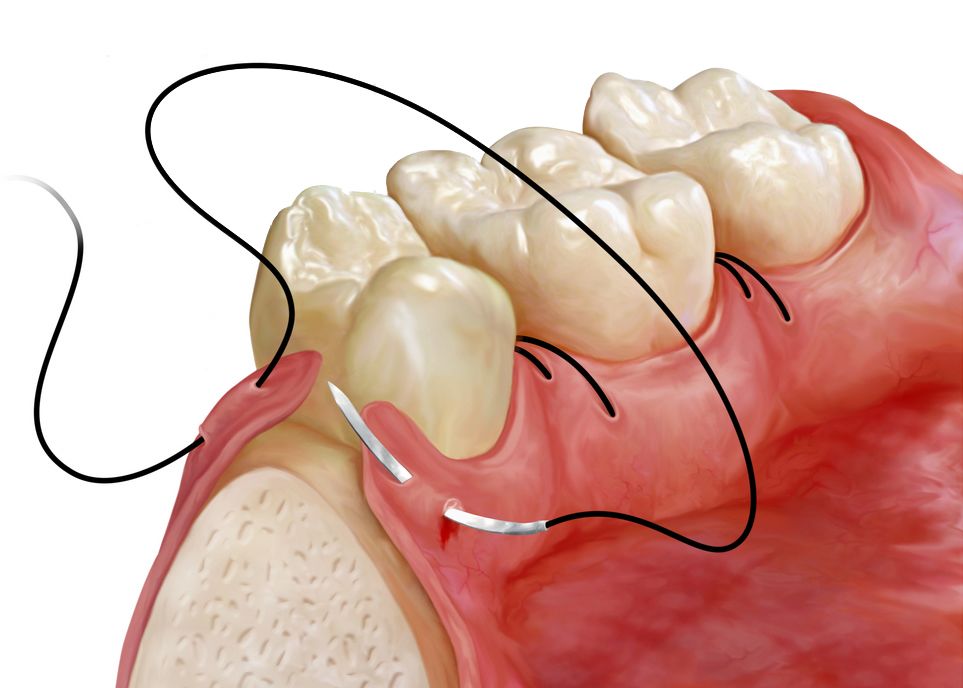  Dental Braided Sutures is fastest growing segment fueling the growth of Dental Suture Market 