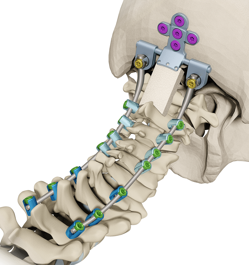 Sculpting the Spine: Innovations and Trends in the Implant Market